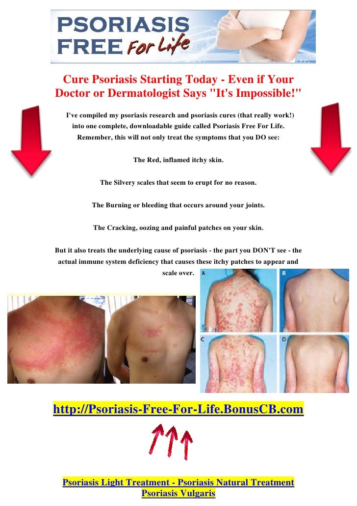 Psoriasis Light Treatment Psoriasis Natural Treatment Psoriasis V…
