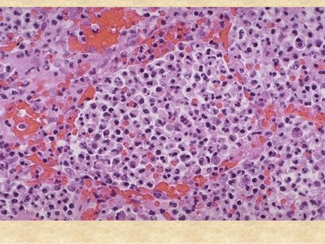 PULMONARY INFECTIONS IN THE CANCEROUS LUNG - Clinical And Pathological Findings Of Epidemic Hemorrhagic Fever PULMONARY INFECTIONS IN THE CANCEROUS LUNG - Clinical And Pathological Findings Of Epidemic Hemorrhagic Fever