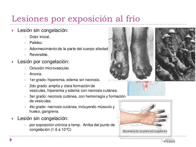 Congelación o quemadura por frío - Offtopic en Taringa! Congelación o quemadura por frío - Offtopic en Taringa!