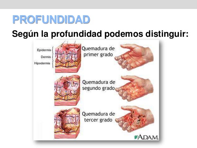 Quemaduras