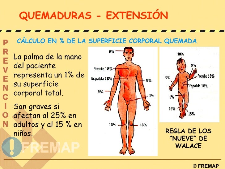 Clasificación De Las Quemaduras Según Su Extensión