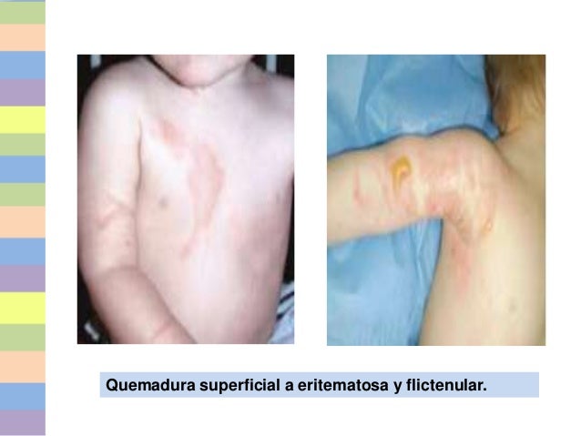 Quemado pediatrico cuidados de enfermeria