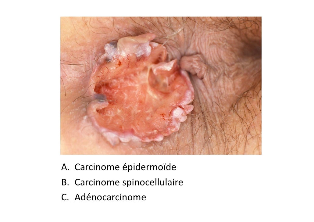 Depistage cancer Melanome
