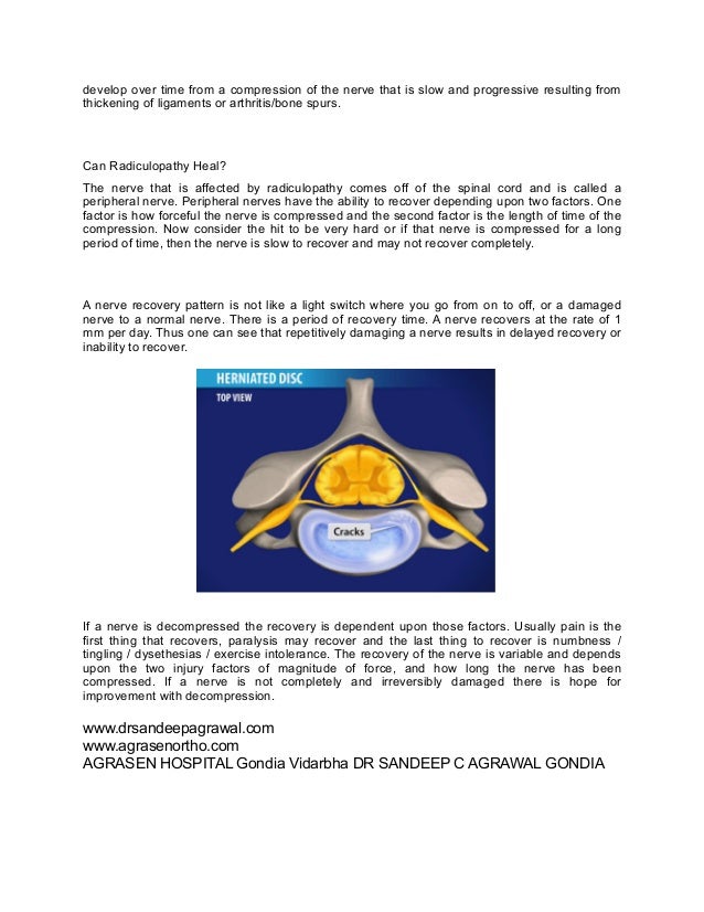 Neurontin Sciatica
