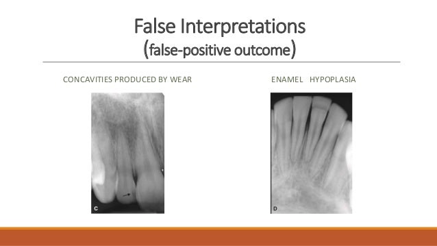 Mach Band Effect In Dentistry