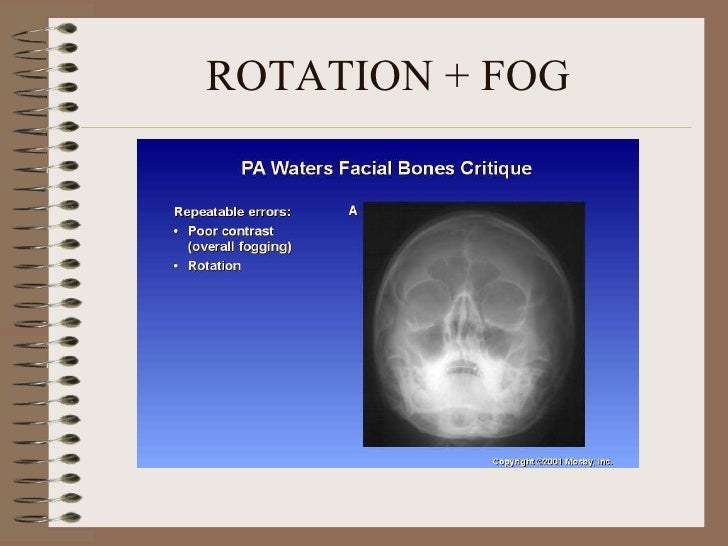 Radiographic artifacts