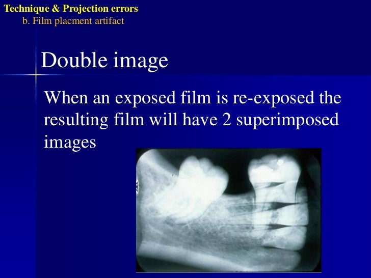 Radiographic errors and artifacts