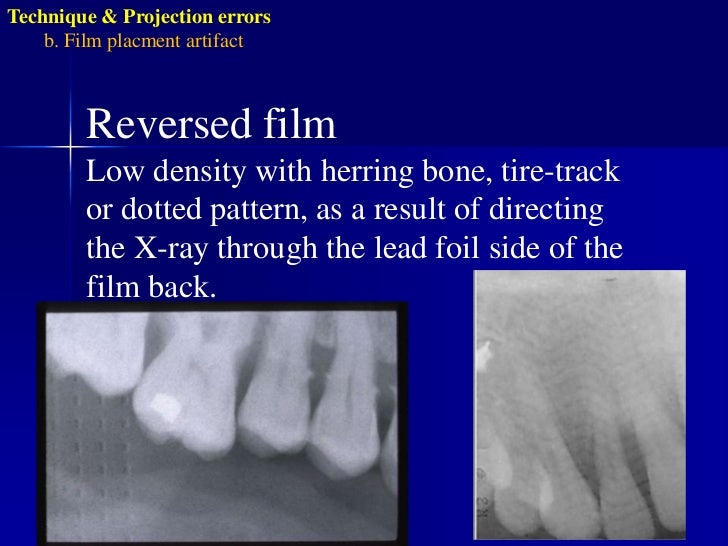 Radiographic errors and artifacts
