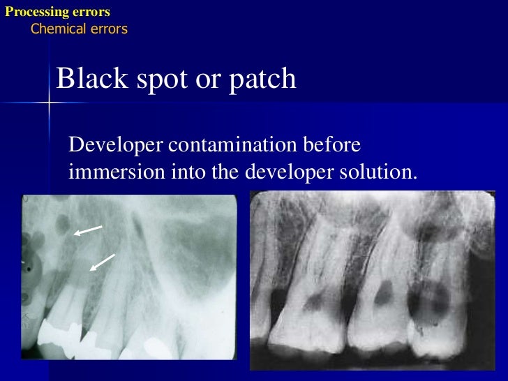 Radiographic errors and artifacts