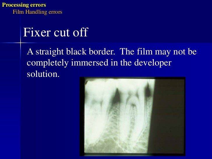 Radiographic errors and artifacts