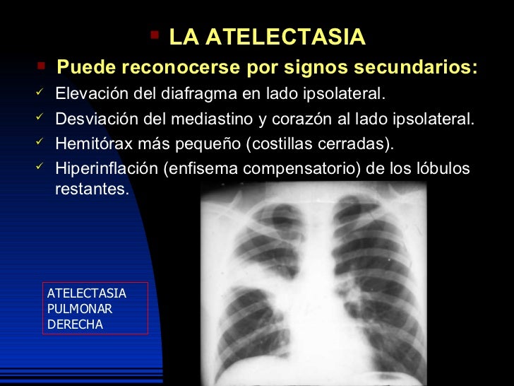 Radiologia 1 Atelectasia