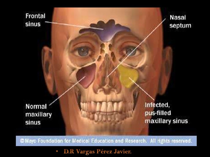 Swollen Sinuses treatment