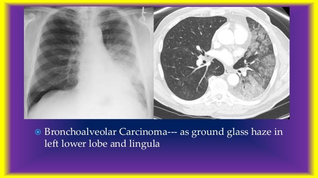 Watch How to Diagnose a Thymoma video Watch How to Diagnose a Thymoma video