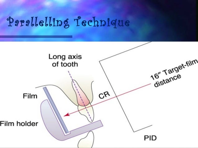 paralleling technique