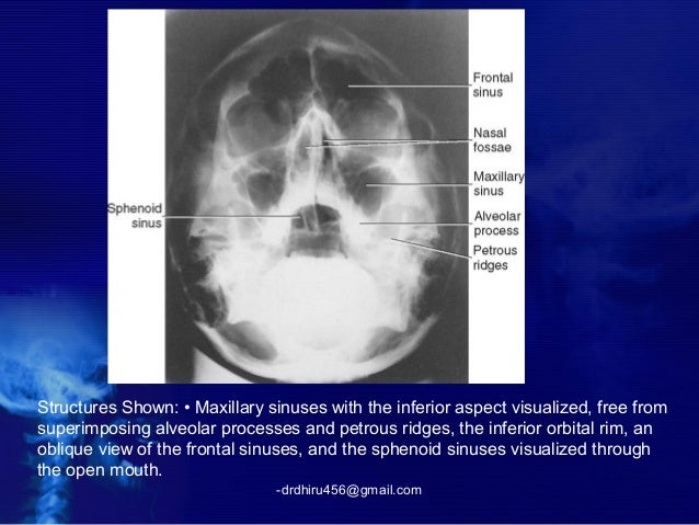 Radiology of nose and pns (by drdhiru456)