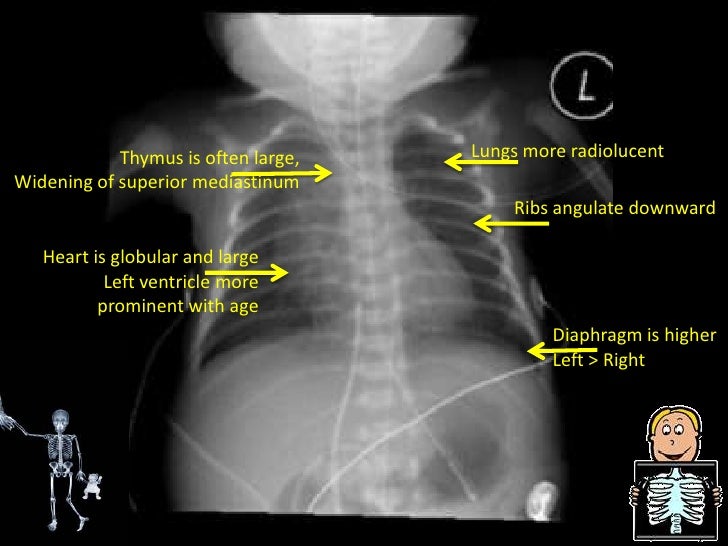 Chest Radiograph for Interns