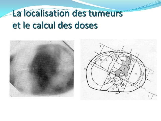 Définition Radiothérapie Externe
