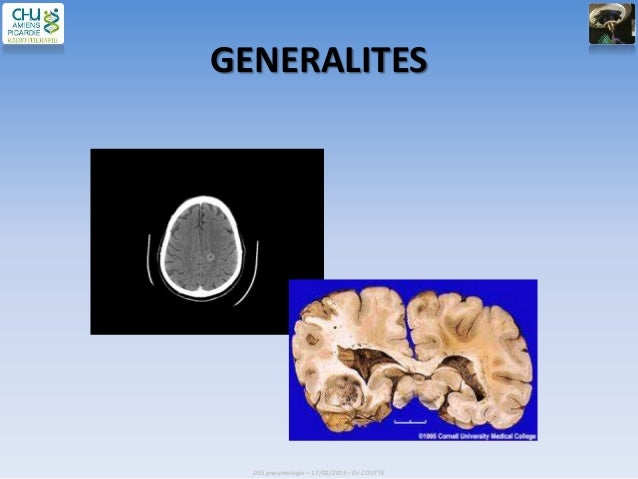 Définition Radiothérapie Stéréotaxique