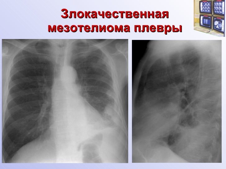 Мезотелиома плевры фото