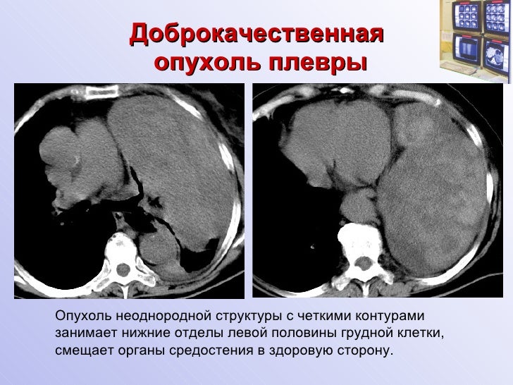 Рак плевры фото