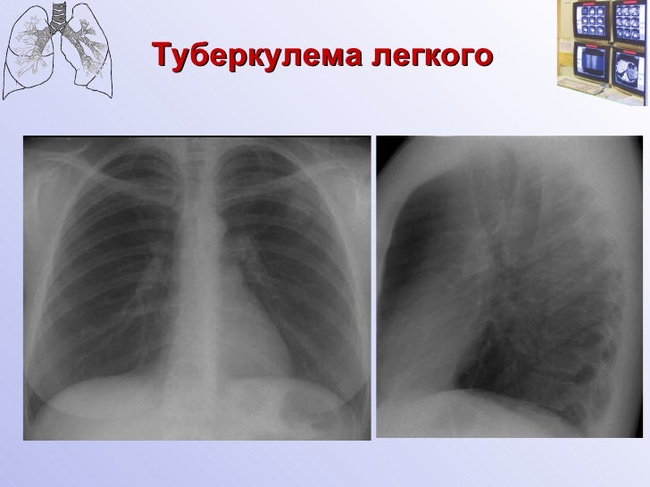 Туберкулема легких фото