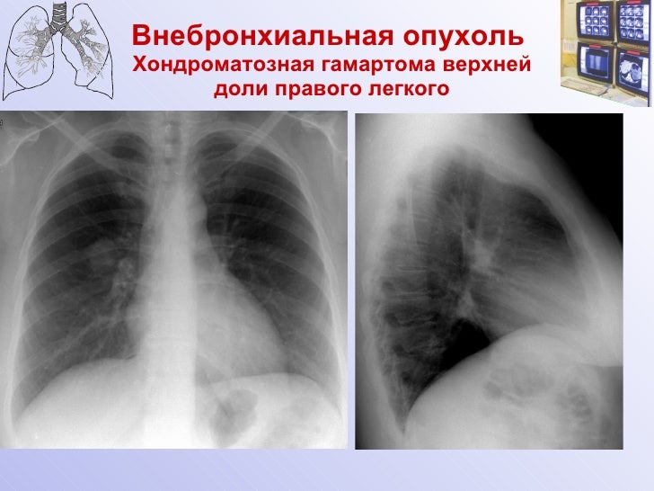 Гамартома лёгкого фото