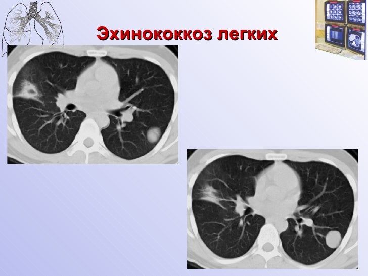 Эхинококкоз легких фото