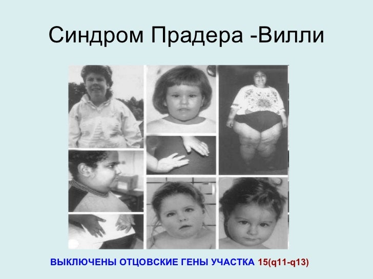 Синдром Прадера-Вилли фото