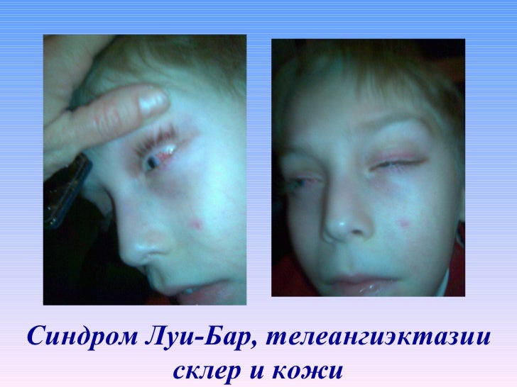 Синдром Видемана-Беквита фото