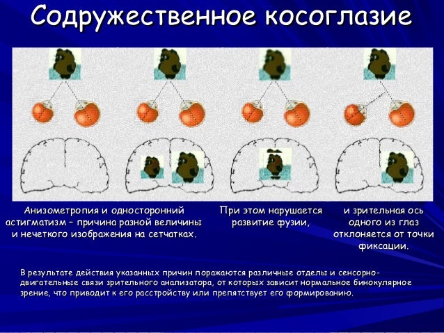 Близорукость у детей быстро