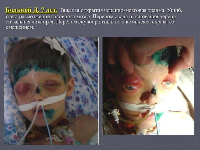 черепно мозговые травмы и первая помощь при дтп сомневался