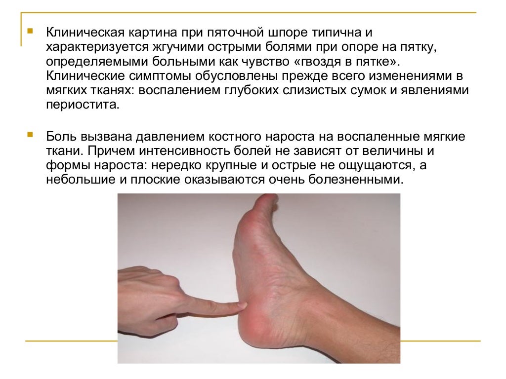 Шпора На Ноге Фото Лечение – Telegraph