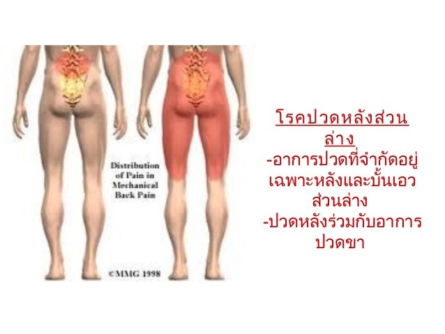 อาการปวดหลัง
