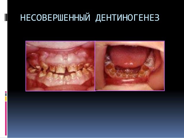 Зубы при несовершенном Зубы при несовершенном
