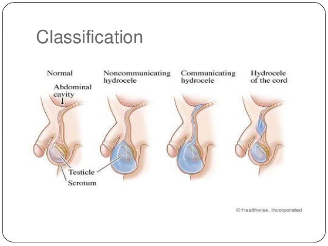 Pathophysiology of hydrocele in adults
