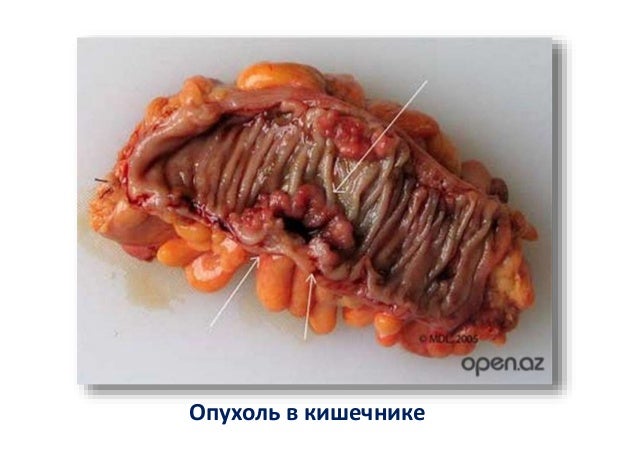 Симптомы псориаза на руке у ребенка