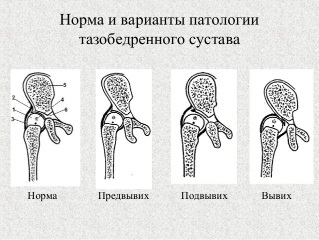 Врожденный вывих сустава у ребенка Врожденный вывих сустава у ребенка