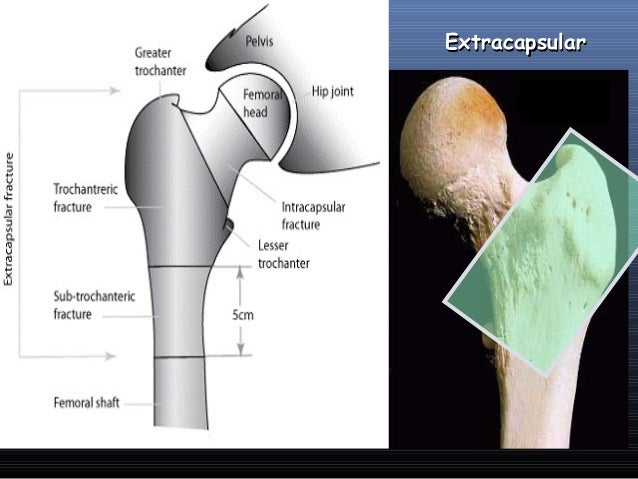 Symptoms of hip fracture in adults