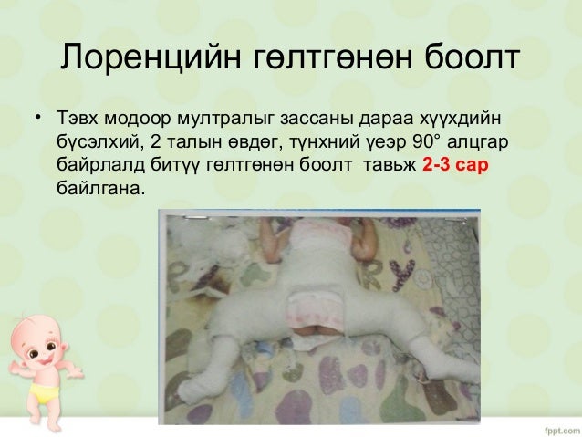 Түнхний төрөлхийн мултрал