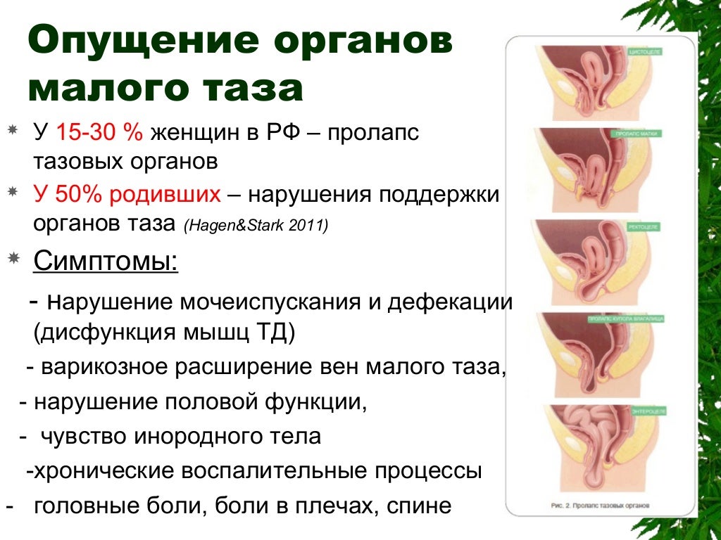 Опущение Органов Малого Таза Фото — Фото Картинки
