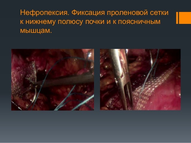 Пластика лмс по хайнс андерсену Пластика лмс по хайнс андерсену