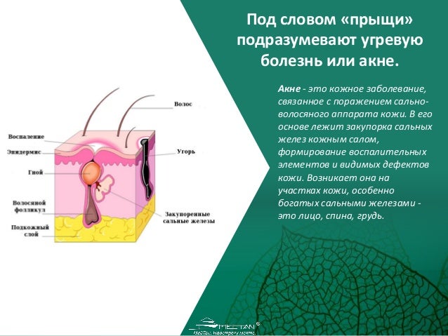 Что провоцирует угри Что провоцирует угри