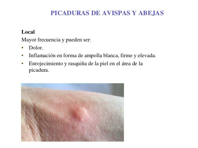 El método de vacío del aumento del miembro