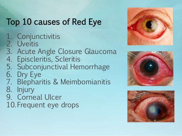top causes of red eye top causes of red eye
