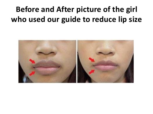 Lip Reduction Home Remedies Lip Reduction Home Remedies