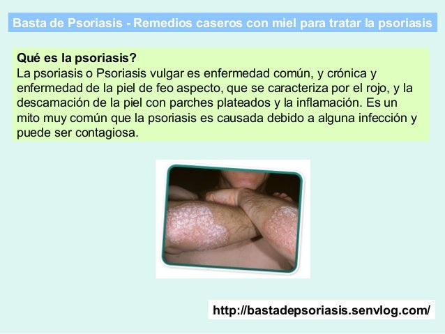 La revisión médica a atopicheskom la dermatitis