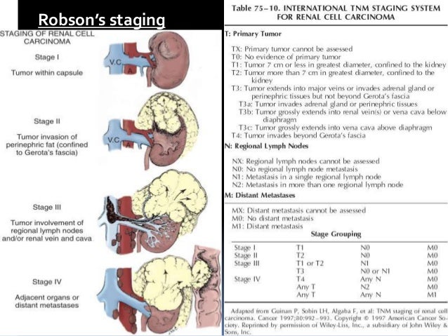 Treatment Options for Kidney Cancer pictures Treatment Options for Kidney Cancer pics