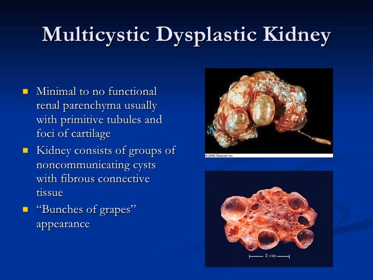 Renal Development Dysplasia 2