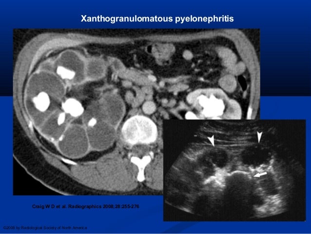 Kidney disease Xgp