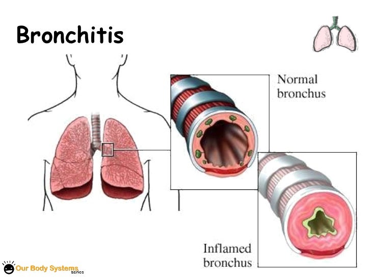 Bronchitis on emaze